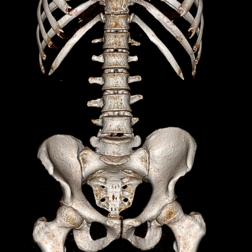 KUB CT scan