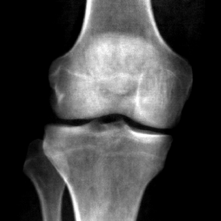 DXA of knee