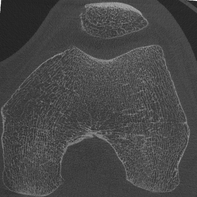 DXA of knee