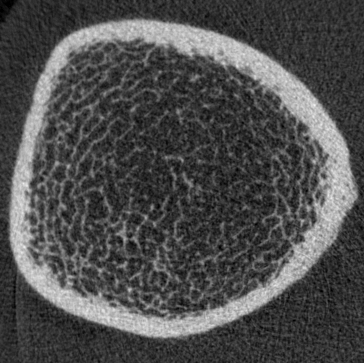 DXA of knee